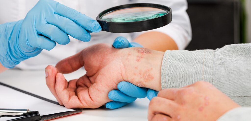 psoriasi