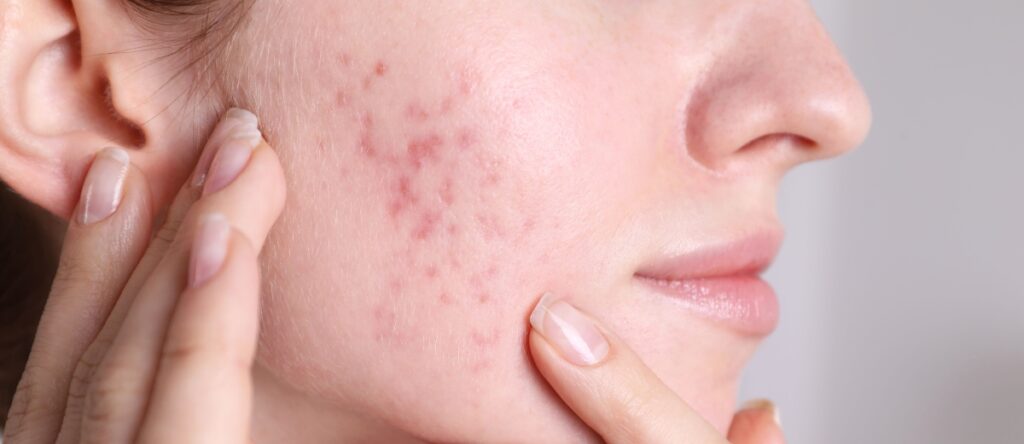 acne santagostino bologna