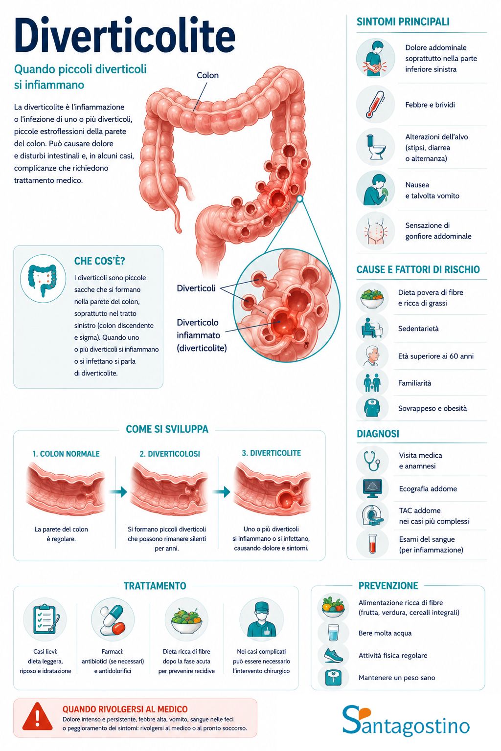 infografica diverticolite