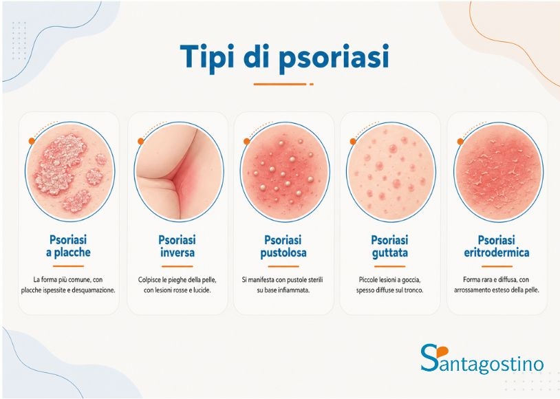 tipi di psoriasi