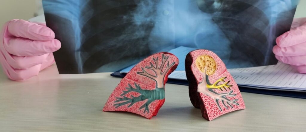 bronchite bologna