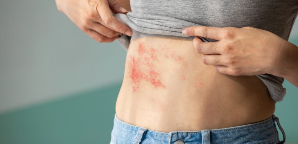 herpes zoster